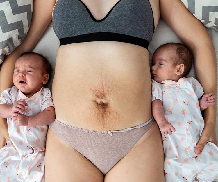 Woman laying on her back showing her stretch marks with her twin babies lying beside her